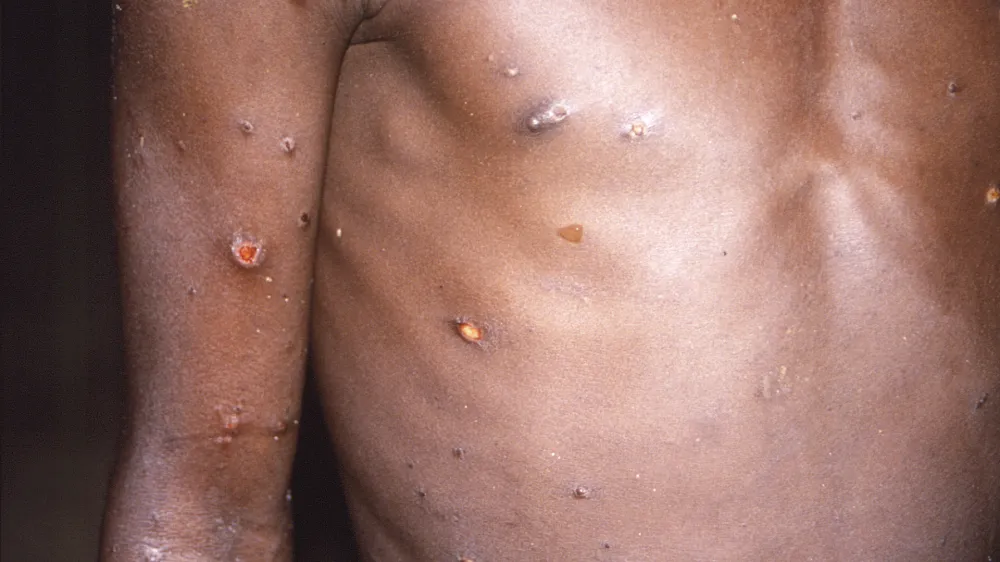 FILE - This 1997 image provided by U.S. Centers for Disease Control and Prevention shows the right arm and torso of a patient, whose skin displayed a number of lesions due to what had been an active case of monkeypox. As health authorities in Europe and elsewhere roll out vaccines and drugs to stamp out the biggest monkeypox outbreak beyond Africa, in 2022, some doctors are acknowledging an ugly reality: The resources to slow the disease's spread have long been available, just not to the Africans who have dealt with it for decades. (CDC via AP, File)