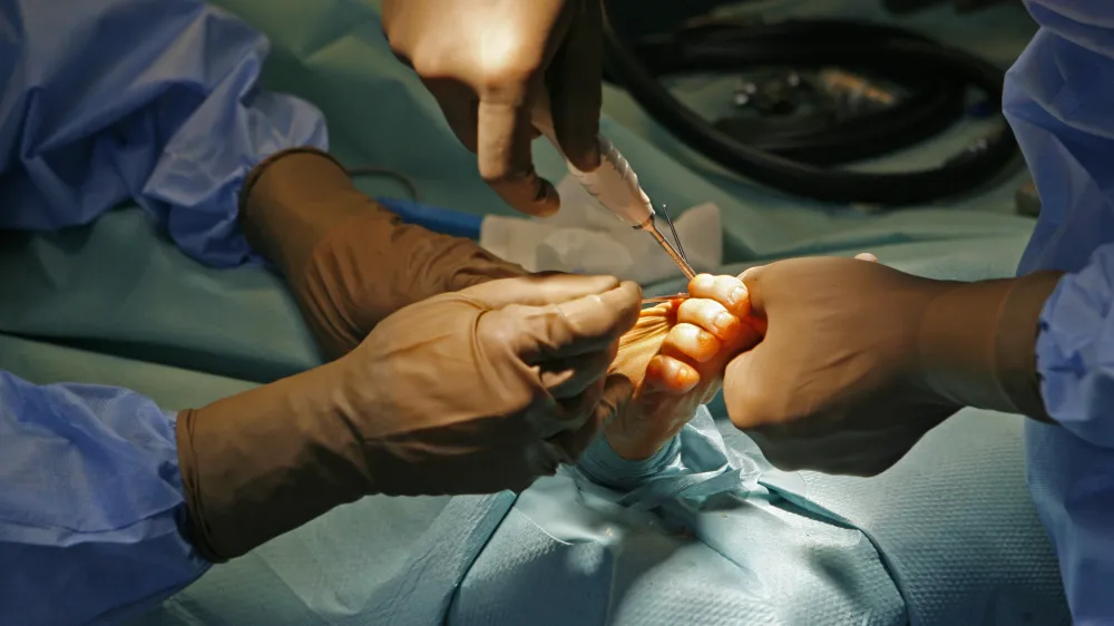 - 23.03.2015 - Ortopedska klinika UKC v Ljubljani - Oddelek za artroskopijo in pokodbe pri portu - operacija nonega palca (haluks valgus), - operacijska dvorana - - kirurki operativni poseg - zdravstvo //FOTO: Toma Skale