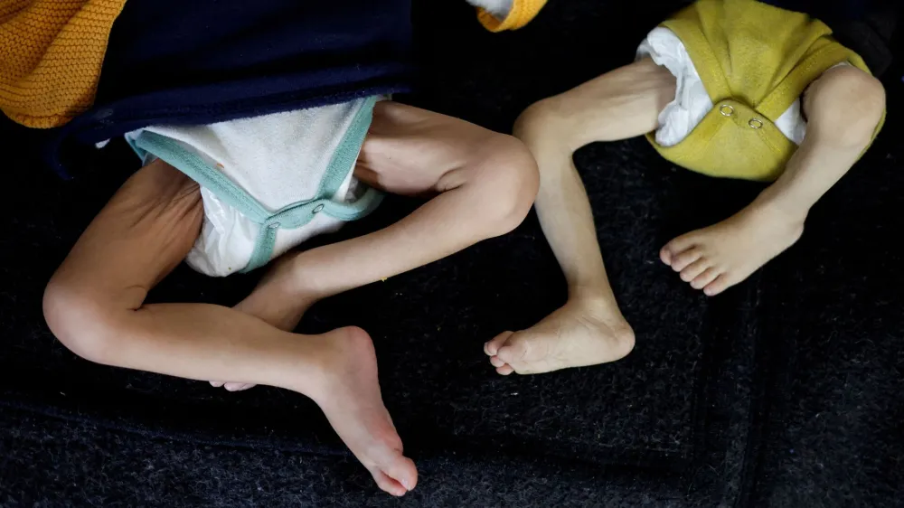 Palestinske otroke, ki trpijo zaradi podhranjenosti in vsesplošne lakote v Gazi, so odpeljali na zdravljenje v zdravstveni center v Rafi. Foto: Reuters