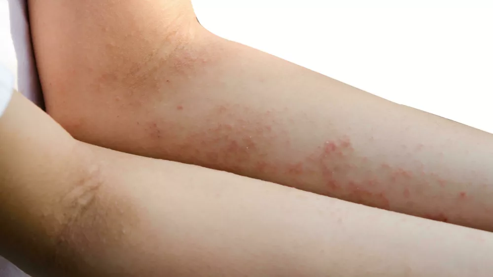 KJ8RGH Rash and skin on the arms, isolated on white background. Foto: Reuters/Alamy