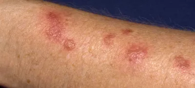 BBM8JN Skin cancer treatment for Actinic/Solar keratoses are pre- cancerous lesions and can be treated by freezing with liquid nitrogen. Image shot 2009. Exact date unknown.Foto: Reuters/Alamy