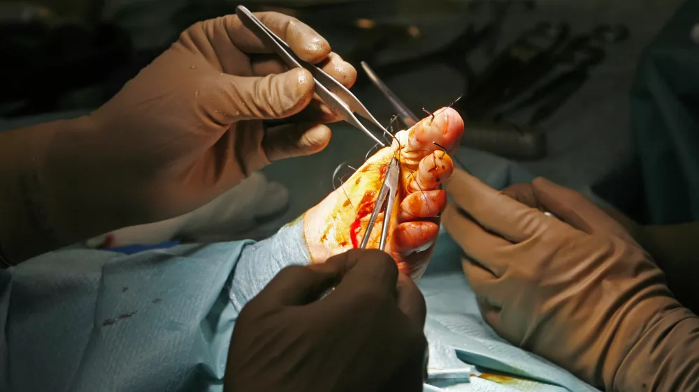 ﻿- 23.03.2015 - Ortopedska klinika UKC v Ljubljani - Oddelek za artroskopijo in poškodbe pri športu - operacija nožnega palca (haluks valgus), - operacijska dvorana - - kirurški operativni poseg - zdravstvo //FOTO: Tomaž Skale