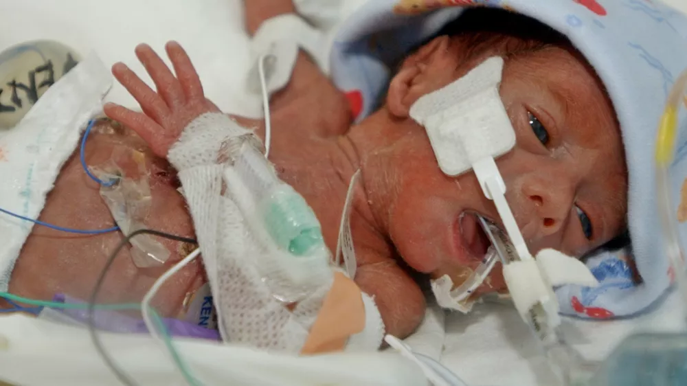 Jerrick De Leon, nedonošenček najmanjši dojenček na svetu tehtal 680 dekagramov