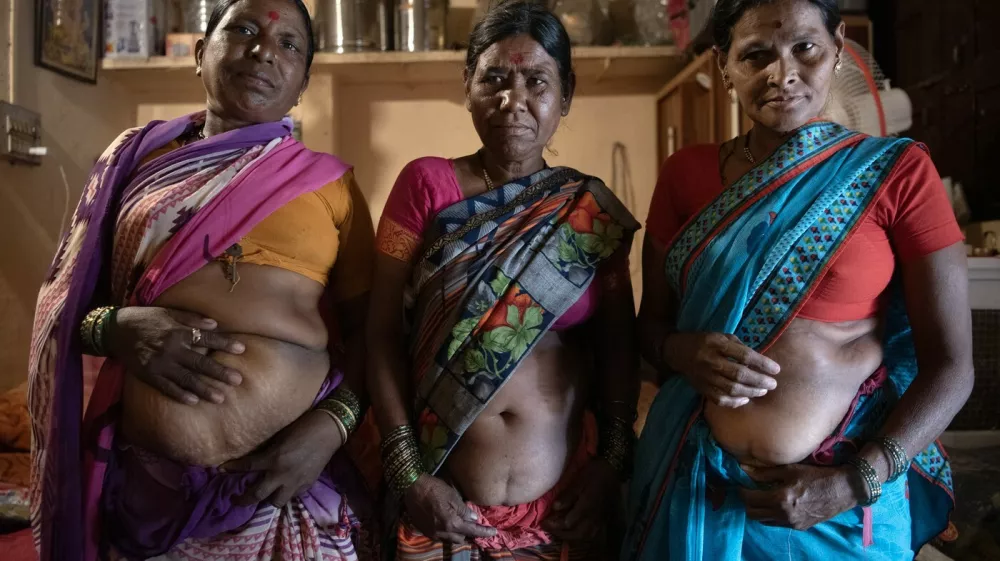 Women who work in the sugarcane fields, all of whom have undergone hysterectomy surgeries, show their scars in Wadgaon, India, May 22, 2023. In Maharashtra's sugar industry, everyone -- contractors, other workers, even doctors -- pushes women toward the surgery.,Image: 859360017, License: Rights-managed, Restrictions:, Model Release: no