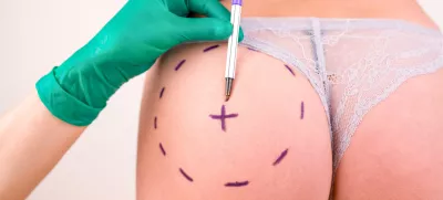Surgeon drawing marks on female body before plastic operation, white background. Liposuction concept / Foto: Georgiy Datsenko