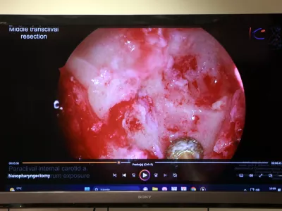 11.07.2025 - novinarska konferenca UKC Ljubljana in Onkološkega inštituta Ljubljana, na kateri bodo predstavili prvo endoskopsko kirurško odstranitev raka nosnega dela žrela z rekonstrukcijo, ki so jo uspešno izvedli kirurgi Klinike ORL UKC Ljubljana, sodelovali bodo specialista otorinolaringologa Domen Vozel in Jure Urbančič, glavna medicinska sestra ORL Klinike Polona Travnikar Pouh, predstojnik Klinike za ORL Robert Šifrer in specialist onkologije z radioterapijo Gaber Plavc; Klinika za ORL, Foto: Tomaž Skale
