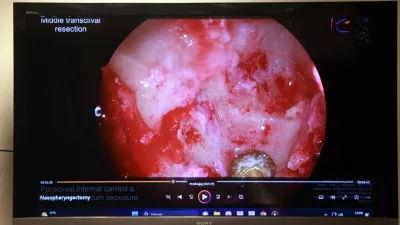 11.07.2025 - novinarska konferenca UKC Ljubljana in Onkološkega inštituta Ljubljana, na kateri bodo predstavili prvo endoskopsko kirurško odstranitev raka nosnega dela žrela z rekonstrukcijo, ki so jo uspešno izvedli kirurgi Klinike ORL UKC Ljubljana, sodelovali bodo specialista otorinolaringologa Domen Vozel in Jure Urbančič, glavna medicinska sestra ORL Klinike Polona Travnikar Pouh, predstojnik Klinike za ORL Robert Šifrer in specialist onkologije z radioterapijo Gaber Plavc; Klinika za ORL, Foto: Tomaž Skale