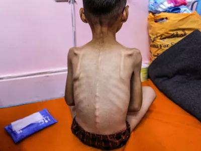 08 August 2025, Palestinian Territories, Gaza: A Palestinian child suffering from severe malnutrition pictured in Nasser Medical Hospital, As Israel continues the closure of the crossings and the non-allowing of humanitarian aid and infant formula to enter the Gaza Strip. Photo: Abed Rahim Khatib/dpa