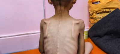 08 August 2025, Palestinian Territories, Gaza: A Palestinian child suffering from severe malnutrition pictured in Nasser Medical Hospital, As Israel continues the closure of the crossings and the non-allowing of humanitarian aid and infant formula to enter the Gaza Strip. Photo: Abed Rahim Khatib/dpa