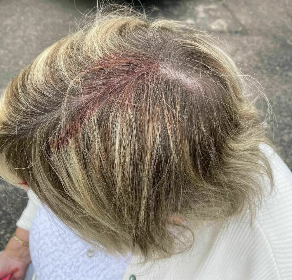 Lesley Wright, after she was attacked by a seagull. A woman was rushed to hospital with a head wound after she was attacked - by a seagull. Lesley Wright, 70, was left with a bleeding scalp that required medical attention after the unprovoked attack by the bird. She was walking to a neighbour's house in Moray in Scotland when the gull swooped in from behind and hit her in the back of the head, leaving her dazed and in pain. Lesley was left with a scar and a bald patch - and is questioning why seagulls are a protected species. Photo released 17/08/2025,Image: 1030041617, License: Rights-managed, Restrictions: Editorial use, commercial use may require additional licenses. We don't use AI to make images which could be mistaken for news photos. AI use will be clearly indicated. Supplied on condition you ensure personal data is processed in compliance with UK GDPR, Model Release: no
