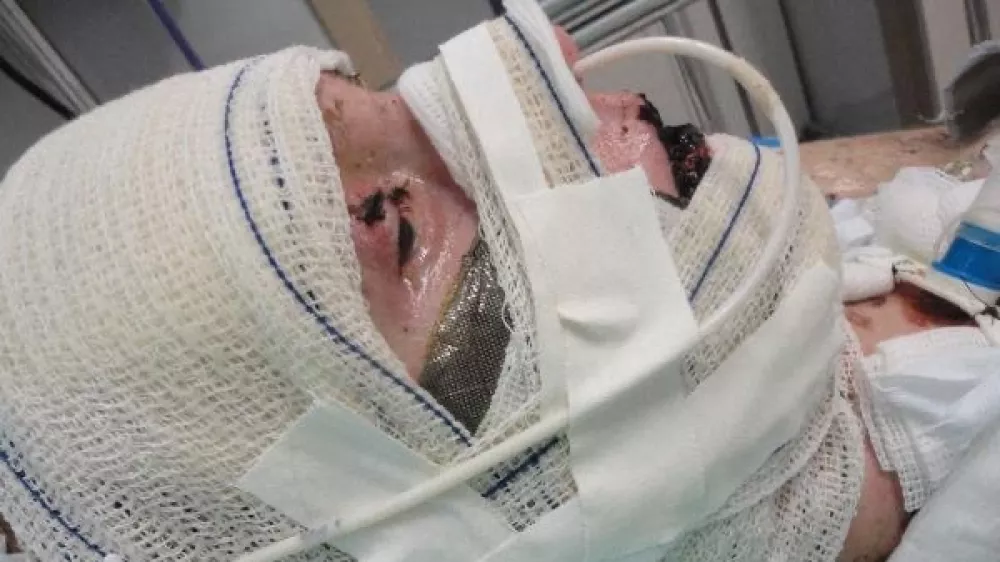 EXCLUSIVE: Story from Jam Press (Steven Johnson Syndrome) Woman left 'burning from inside out' after taking Ibuprofen devastated as doctors say vision is lost for goodA woman who was left 'burning from the inside out' and in a 17-day coma from an extreme reaction to Ibuprofen will never get her sight back, doctors have confirmed.Jaqueline Gmack took the over-the-counter medication to alleviate menstrual cramps, but soon started to experience terrifying symptoms, including blistering skin.The 32-year-old was taken to hospital and put into an induced coma, with doctors discovering her body's reaction to the medication had triggered a rare condition called Stevens-Johnson syndrome (SJS).It was a "miracle" she survived the traumatising incident, but despite 26 operations to save her vision, doctors have recently confirmed the vision in her right eye is lost for good, and vision in her left eye is extremely limited."It has taken a while for the reality to sink in – I entered a period of real mourning," Jaqueline, from Papanduva, Brazil, told NeedToKnow."I don't recognise faces on the street, I can barely see who's next to me."I can't walk alone because I can't see steps, holes, or obstacles."Jaqueline has been suffering corneal perforation – where the cornea, in the front part of the eye, has a hole or opening – since the incident, and has recently had two corneal transplants to prevent her eye from leaking.The issue means she can't regain clear vision, but the first transplant wasn't fully successful, leading to a second in February which involved having her eyelids sewn shut.She said: "I was devastated and overwhelmed because I didn't want my eyelids to be sewn, but I knew it was the only option to save my eye from further corneal damage."A few months on, the stitches eventually fell out, but doctors delivered the devastating news that she will no longer be able to see out of her right eye due to the extensive damage caused by.26 Aug 2025Pictured: WARNING, CONTAINS GRAPHIC CONTENTStory from Jam Press (Steven Johnson Syndrome) Pictured: Jaqueline Gmack in hospital.Woman left 'burning from inside out' after taking Ibuprofen devastated as doctors say vision is lost for goodA woman who was left 'burning from the inside out' and in a 17-day coma from an extreme reaction to Ibuprofen will never get her sight back, doctors have confirmed.Jaqueline Gmack took the over-the-counter medication to alleviate menstrual cramps, but soon started to experience terrifying symptoms, including blistering skin.The 32-year-old was taken to hospital and put into an induced coma, with doctors discovering her body's reaction to the medication had triggered a rare condition called Stevens-Johnson syndrome (SJS).It was a "miracle" she survived the traumatising incident, but despite 26 operations to save her vision, doctors have recently confirmed the vision in her right eye is lost for good, and vision in her left eye is extremely limited.,Image: 1031420443, License: Rights-managed, Restrictions: NO Australia, Germany, Norway, South Korea, Sweden, United Kingdom, United States, Unknown Country, Model Release: no, Pictured: Jaqueline Gmack