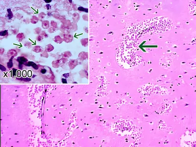 A section of the cerebral portion of the brain of a patient with primary amoebic meningoencephalitis, stained with hematoxylin and eosin, showing large clumps of Naegleria fowleri trophozoites and destruction of normal tissue architecture cerebral. The cysts are not visible. Magnification: 100x. Inset: Higher magnification (1000x) of Naegleria fowleri trophozoites (arrows) with characteristic nuclear morphology,Image: 887005805, License: Rights-managed, Restrictions: RM MR=No, Model Release: no