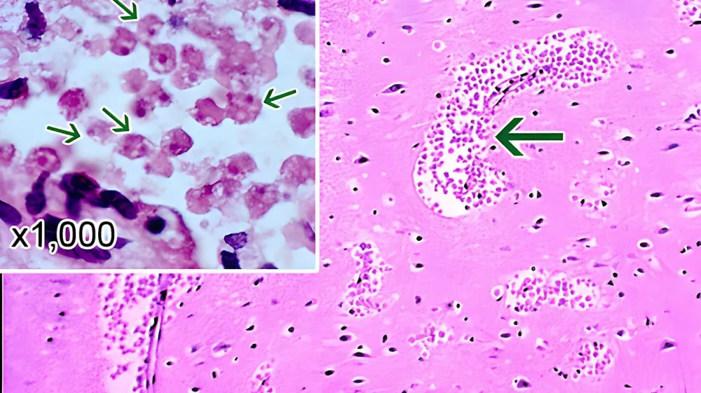 A section of the cerebral portion of the brain of a patient with primary amoebic meningoencephalitis, stained with hematoxylin and eosin, showing large clumps of Naegleria fowleri trophozoites and destruction of normal tissue architecture cerebral. The cysts are not visible. Magnification: 100x. Inset: Higher magnification (1000x) of Naegleria fowleri trophozoites (arrows) with characteristic nuclear morphology,Image: 887005805, License: Rights-managed, Restrictions: RM MR=No, Model Release: no