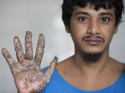 DHAKA, BANGLADESH - 2016/08/09: Abul Vajondar was identified with epidermodysplasia verruciformis a rare skin disease. After surgery he is better now and under treatment at the Dhaka Medical College Hospital. Abul Vajondar has been suffering bark-like warts on his hands and feet since four years. (Photo by K M Asad/LightRocket via Getty Images) / Foto: K M Asad