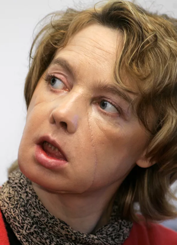 ** FILE ** Isabelle Dinoire, the woman who received the world's first partial face transplant with a new nose, chin and mouth in a transplant operation on Nov. 27, 2005, addresses the media in Amiens France in this file photo taken Monday Feb. 6, 2006. An ethics panel on Wednesday Oct. 25, 2006, approved a London hospital's plan to carry out what could be the world's first full-face transplant, but no candidates for the surgery have yet been selected, a spokesman said. The Special Ethics Committee of the Royal Free Hospital approved a proposal for a series of four transplant operations, said Neil Huband, spokesman for The Face Trust. (AP Photo/Michel Spingler)