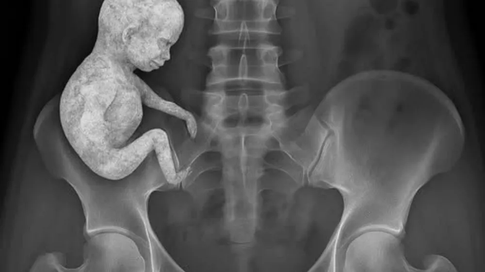 Ta zelo nenavaden primerek je ostal v trebuhu ženske dve leti.