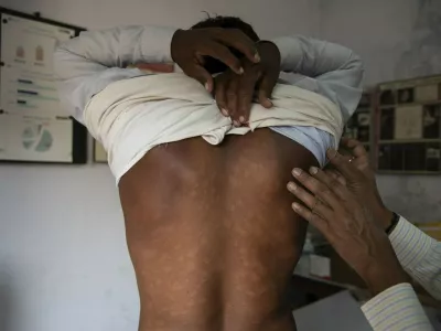 Primer gobavosti pri 25 let starem Indijcu. Na Hrvaškem so bolezen odkrili pri Nepalcu.