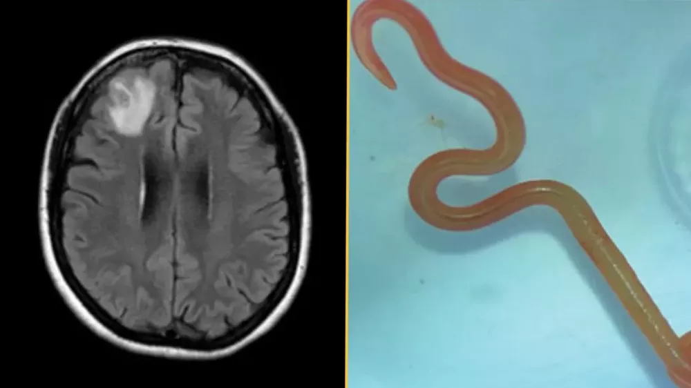 Slika možganov in vsiljivca. / Foto: Cdc