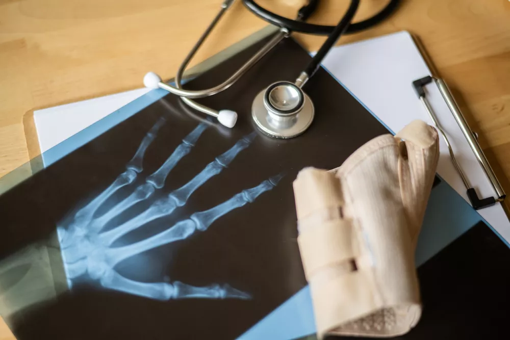 Orthopedic doctor examining a hand x-ray on a wooden desk, with a stethoscope and an orthopedic brace resting on the radiography, suggesting a diagnosis of a traumatology case / Foto: Nanci Santos Getty Images
