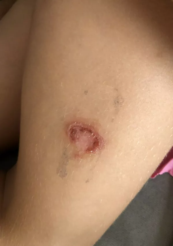 impetigo, akterijska okužba, okužba, rdečkaste ranice / Foto: Matjaž Terzič