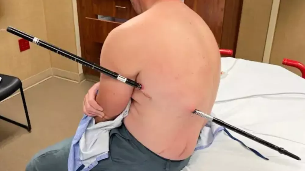 This photo provided by David Cifaldi shows Cifaldi while he was being treated Monday, July 20, 2026, at St. Vincent Regional Hospital in Billings, Mont. (Jessee Ross via AP)