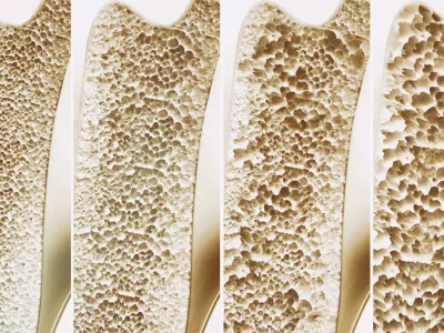V oddaji bomo poudarili pomen zgodnjega odkrivanja&nbsp;bolnikov, pri katerih obstaja visoko tveganje za osteoporozne zlome. Foto: Reuters/Alamy / Foto: Foto: Reuters/alamy