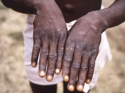 FILE - This 1997 image provided by the CDC during an investigation into an outbreak of monkeypox, which took place in the Democratic Republic of the Congo (DRC), formerly Zaire, and depicts the dorsal surfaces of the hands of a monkeypox case patient, who was displaying the appearance of the characteristic rash during its recuperative stage. Health authorities in Africa said Thursday, June 30, 2022 they are treating the expanding monkeypox outbreak there as an emergency and are calling on rich countries to share the world's limited supply of vaccines in an effort to avoid the glaring equity problems seen during the COVID-19 pandemic. (CDC via AP, File)