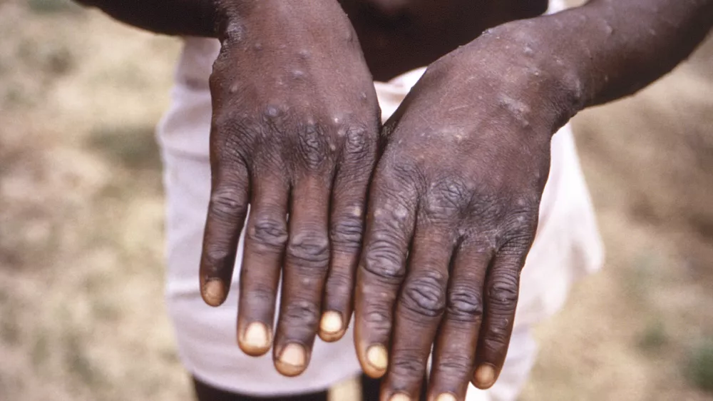 FILE - This 1997 image provided by the CDC during an investigation into an outbreak of monkeypox, which took place in the Democratic Republic of the Congo (DRC), formerly Zaire, and depicts the dorsal surfaces of the hands of a monkeypox case patient, who was displaying the appearance of the characteristic rash during its recuperative stage. Health authorities in Africa said Thursday, June 30, 2022 they are treating the expanding monkeypox outbreak there as an emergency and are calling on rich countries to share the world's limited supply of vaccines in an effort to avoid the glaring equity problems seen during the COVID-19 pandemic. (CDC via AP, File)