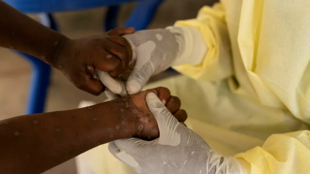 FILE PHOTO: Christian Musema, a laboratory nurse, takes a sample from a child declared a suspected case of Mpox at the treatment centre in Munigi, following Mpox cases in Nyiragongo territory near Goma, North Kivu province, Democratic Republic of the Congo July 19, 2024. REUTERS/Arlette Bashizi/File Photo