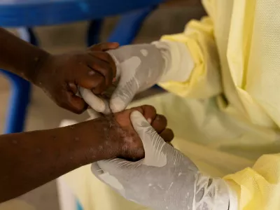 FILE PHOTO: Christian Musema, a laboratory nurse, takes a sample from a child declared a suspected case of Mpox at the treatment centre in Munigi, following Mpox cases in Nyiragongo territory near Goma, North Kivu province, Democratic Republic of the Congo July 19, 2024. REUTERS/Arlette Bashizi/File Photo