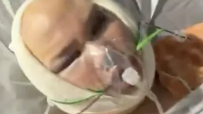 WARNING, GRAPHIC CONTENT -Story from Jam Press (Blind After Facelift)Pictured: Video grab: Joni after surgery.Big Brother star left 'unrecognisable and BLIND' after undergoing extreme facelift that doctors in Turkey REFUSED to doAn influencer was left "unrecognisable and blind" after undergoing an extreme facelift that doctors in Turkey &ndash; a country known for its controversial procedures &ndash; refused to perform.Joni Hesselgren had previously undergone several procedures abroad with no issues including a rhinoplasty, a 360 liposuction and dental work.But when the reality TV star was denied his latest request, due to his age, he simply jetted off from Turkey to South Korea instead.He went under the knife to celebrate his 30th birthday."I consulted with several Turkish surgeons about the possibility of getting a lower facelift," the Big Brother Finland star told NeedToKnow."They told me they wouldn't perform a facelift on someone my age, and honestly, I do respect that decision."I've always been unhappy with how my jawline looks, so I thought maybe tightening the skin could help improve it."V-line surgery had been a dream of mine for several years but I was absolutely terrified of going through with it."I was desperately trying to find an alternative, something easier and faster that could give me a similar result."But as time went on, I realised I just had to man up and go through with the surgery I originally wanted."Joni travelled to the South Korean capital Seoul to undergo the operation.He ended up losing a lot of blood during the procedure.Joni said: "The surgeons suggested pairing my V-line surgery with a deep plane facelift."Of course I was thrilled to hear that because it meant I could get everything I ever wanted done in a single procedure."And I had three different surgeons working on me."One surgeon handled the facial contouring, which included V-line surgery and cheekbone reduction."Another performed the facelift, and a third did my lip lift."They told me afterwards that the surgery was more difficult than usual because I bled quite a lot during the procedure."The first night was pretty uncomfortable, I couldn't close my mouth properly, it just stayed open."When they discharged me the next morning, I took a taxi back to the Airbnb."That's when things really started to escalate and my swelling suddenly got much worse."Joni's troubles were about to get even worse on the second and third days after the operation.He said: "On day two, I started losing my eyesight."I tried to fight it by stretching my eyelids open so I could see something, anything."In the evening, my friends had to walk me to the bathroom, feed me, wash me, basically take care of everything for me."That second night, I barely slept. I was sitting there in the dark with my eyes completely swollen shut, unable to see anything."At one point, I even tried going to the bathroom by myself which, in hindsight, was a terrible idea considering I was basically blind and had zero awareness of my surroundings."I ended up hitting my head on the wall."Luckily for Joni, his friends woke up due to the noise and helped him to the bathroom.Joni spent that night crying because he had to remain upright and couldn't sleep.He said: "I had a follow-up appointment at the clinic on post-op day three, at this point I still couldn't see anything at all."I couldn't even tell whether it was day or night."My friends helped me into a taxi and guided me everywhere, I couldn't see shadows, lights, shapes, nothing."The only thing I could feel was the warmth of the sun on my face."When we arrived at the clinic, they immediately took me to a hyperbaric chamber for oxygen therapy."It's basically a pressurised chamber that feels a bit like being on a plane during takeoff or landing."Koreans really take their de-swelling treatments seriously because my eyes started to open within a few hours."The swelling went down super fast, I was so relieved."The total time I was effectively blind was about 12 to 15 hours."I can't wait to see the final results."I guess we'll see them in about six months!"Joni also had advice for anyone thinking about undergoing similar procedures in a foreign country.He added: "If you ever consider going through this many procedures, please take a friend with you."The recovery process is physically exhausting, but it's a lot to go through mentally as well."You really need love and support during that time."ENDSEDITOR'S NOTE: Video Usage Licence: (EXCLUSIVE) We have obtained an exclusive licence from the copyright holder. A copy of the licence is available on request.Video Restrictions: None.,Image: 1093447500, License: Rights-managed, Restrictions: EDITOR'S NOTE: Video Usage Licence: (EXCLUSIVE) We have obtained an exclusive licence from the copyright holder. A copy of the licence is available on request.Video Restrictions: None., Model Release: no 