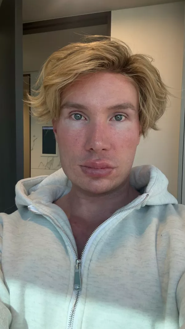 WARNING, GRAPHIC CONTENT -Story from Jam Press (Blind After Facelift)Pictured: Joni.Big Brother star left 'unrecognisable and BLIND' after undergoing extreme facelift that doctors in Turkey REFUSED to doAn influencer was left "unrecognisable and blind" after undergoing an extreme facelift that doctors in Turkey &ndash; a country known for its controversial procedures &ndash; refused to perform.Joni Hesselgren had previously undergone several procedures abroad with no issues including a rhinoplasty, a 360 liposuction and dental work.But when the reality TV star was denied his latest request, due to his age, he simply jetted off from Turkey to South Korea instead.He went under the knife to celebrate his 30th birthday."I consulted with several Turkish surgeons about the possibility of getting a lower facelift," the Big Brother Finland star told NeedToKnow."They told me they wouldn't perform a facelift on someone my age, and honestly, I do respect that decision."I've always been unhappy with how my jawline looks, so I thought maybe tightening the skin could help improve it."V-line surgery had been a dream of mine for several years but I was absolutely terrified of going through with it."I was desperately trying to find an alternative, something easier and faster that could give me a similar result."But as time went on, I realised I just had to man up and go through with the surgery I originally wanted."Joni travelled to the South Korean capital Seoul to undergo the operation.He ended up losing a lot of blood during the procedure.Joni said: "The surgeons suggested pairing my V-line surgery with a deep plane facelift."Of course I was thrilled to hear that because it meant I could get everything I ever wanted done in a single procedure."And I had three different surgeons working on me."One surgeon handled the facial contouring, which included V-line surgery and cheekbone reduction."Another performed the facelift, and a third did my lip lift."They told me afterwards that the surgery was more difficult than usual because I bled quite a lot during the procedure."The first night was pretty uncomfortable, I couldn't close my mouth properly, it just stayed open."When they discharged me the next morning, I took a taxi back to the Airbnb."That's when things really started to escalate and my swelling suddenly got much worse."Joni's troubles were about to get even worse on the second and third days after the operation.He said: "On day two, I started losing my eyesight."I tried to fight it by stretching my eyelids open so I could see something, anything."In the evening, my friends had to walk me to the bathroom, feed me, wash me, basically take care of everything for me."That second night, I barely slept. I was sitting there in the dark with my eyes completely swollen shut, unable to see anything."At one point, I even tried going to the bathroom by myself which, in hindsight, was a terrible idea considering I was basically blind and had zero awareness of my surroundings."I ended up hitting my head on the wall."Luckily for Joni, his friends woke up due to the noise and helped him to the bathroom.Joni spent that night crying because he had to remain upright and couldn't sleep.He said: "I had a follow-up appointment at the clinic on post-op day three, at this point I still couldn't see anything at all."I couldn't even tell whether it was day or night."My friends helped me into a taxi and guided me everywhere, I couldn't see shadows, lights, shapes, nothing."The only thing I could feel was the warmth of the sun on my face."When we arrived at the clinic, they immediately took me to a hyperbaric chamber for oxygen therapy."It's basically a pressurised chamber that feels a bit like being on a plane during takeoff or landing."Koreans really take their de-swelling treatments seriously because my eyes started to open within a few hours."The swelling went down super fast, I was so relieved."The total time I was effectively blind was about 12 to 15 hours."I can't wait to see the final results."I guess we'll see them in about six months!"Joni also had advice for anyone thinking about undergoing similar procedures in a foreign country.He added: "If you ever consider going through this many procedures, please take a friend with you."The recovery process is physically exhausting, but it's a lot to go through mentally as well."You really need love and support during that time."ENDSEDITOR'S NOTE: Video Usage Licence: (EXCLUSIVE) We have obtained an exclusive licence from the copyright holder. A copy of the licence is available on request.Video Restrictions: None.,Image: 1093447474, License: Rights-managed, Restrictions: EDITOR'S NOTE: Video Usage Licence: (EXCLUSIVE) We have obtained an exclusive licence from the copyright holder. A copy of the licence is available on request.Video Restrictions: None., Model Release: no 
