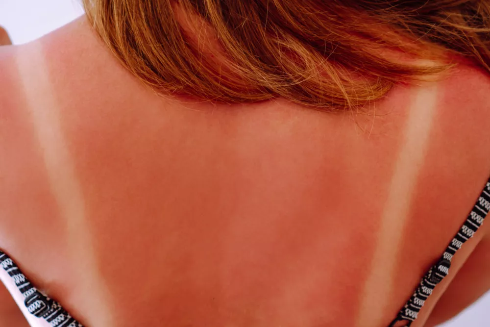 Back view of young woman with light traces of swimsuit on sunburnt naked back on blue background. Summer, UV protection, health, cosmetology, dermatology, sunbathing, sun block, tanning, skincare. / Foto: Jane Rubtsova Getty Images
