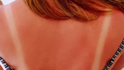 Back view of young woman with light traces of swimsuit on sunburnt naked back on blue background. Summer, UV protection, health, cosmetology, dermatology, sunbathing, sun block, tanning, skincare. / Foto: Jane Rubtsova Getty Images