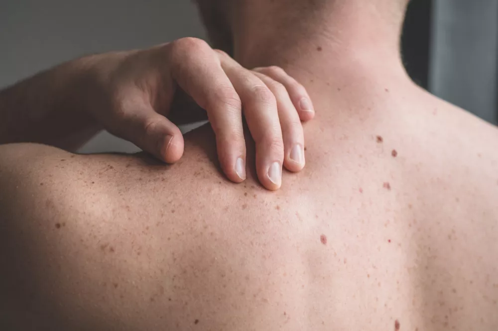 Checking benign moles. Close up detail of the bare skin on a man back with scattered moles and freckles. Sun effect on skin. Birthmarks on skin
