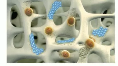 osteoporoza kosti gostota