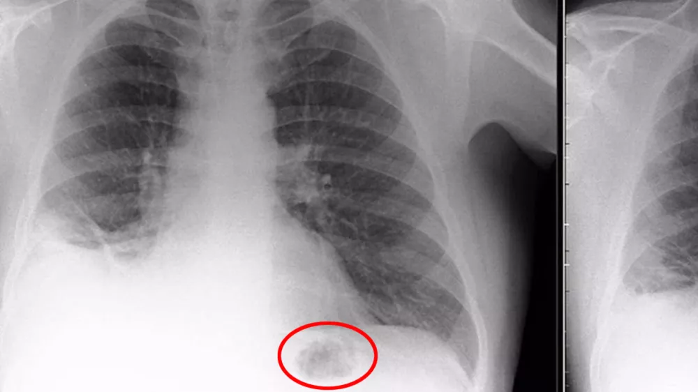 The blockage in the bottom right of the X-Ray (L) before it was removed and Paul's lungs once the toy cone was removed (R). A man who inhaled a Playmobil cone that was lodged in his lung for 40 years has spoken out about his ordeal. See ROSS PARRY story RPYCONE. Doctors feared father-of-two Paul Baxter had cancer after a dark mass was found on his chest - only to discover on the operating table it was part of a police traffic set he had received as a seventh birthday present. The postman had initially been referred to his local hospital after months of ill health, complaining about a persistent cough. Amazingly Paul, who is now 50, cannot remember inhaling the cone.,Image: 350730336, License: Rights-managed, Restrictions: follow us on twitter - @swnsbrowse our website - swns.comemail pix@swns.com, Model Release: no 